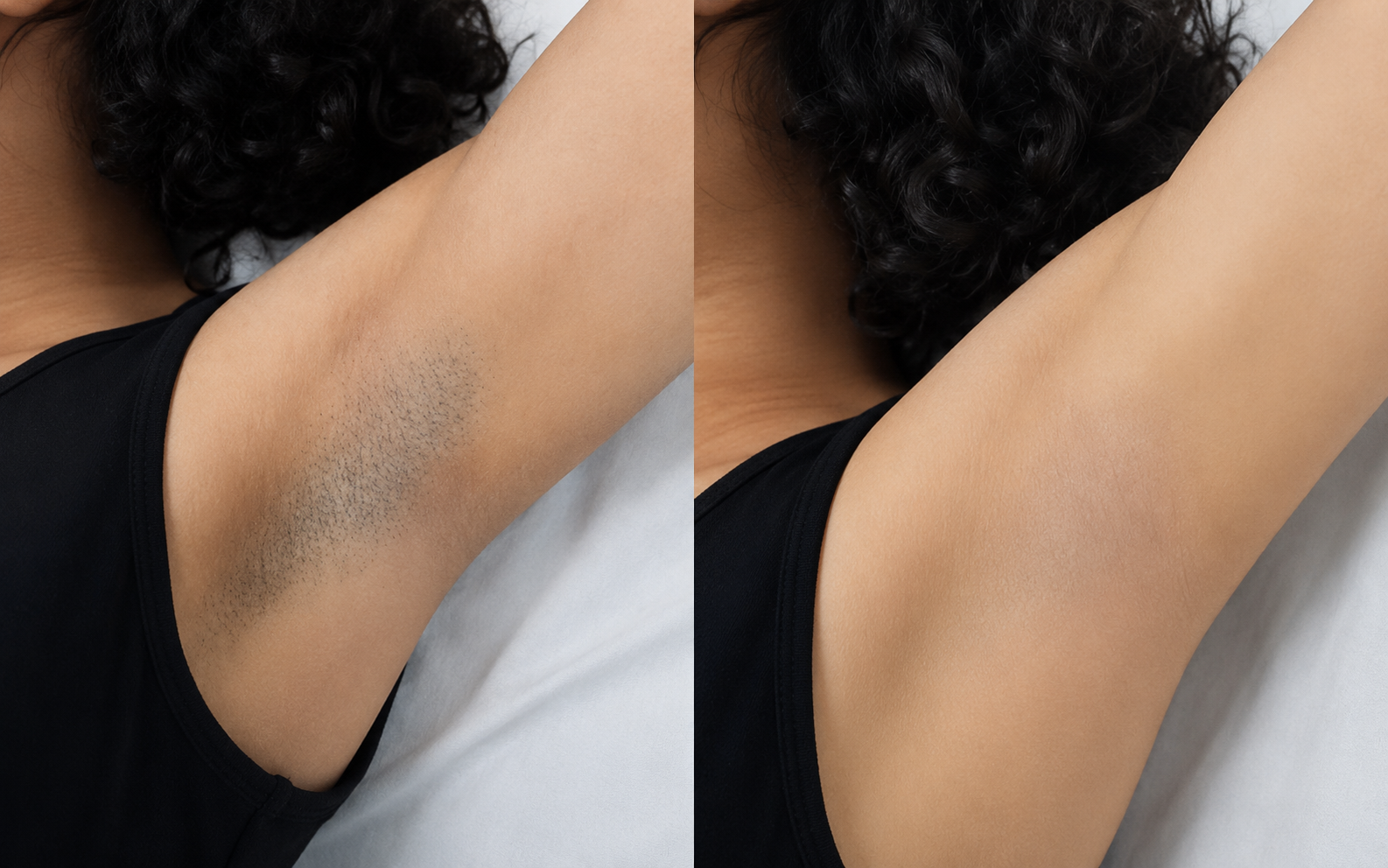 Antes e depois — Axila