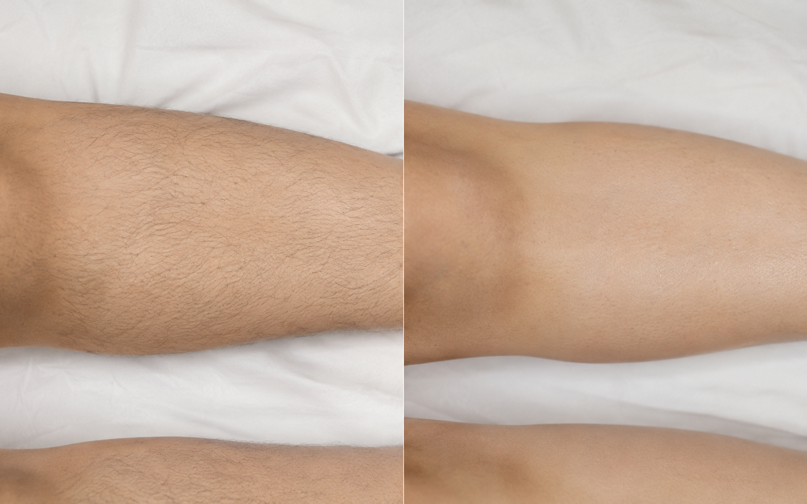 Antes e depois — Meia Perna