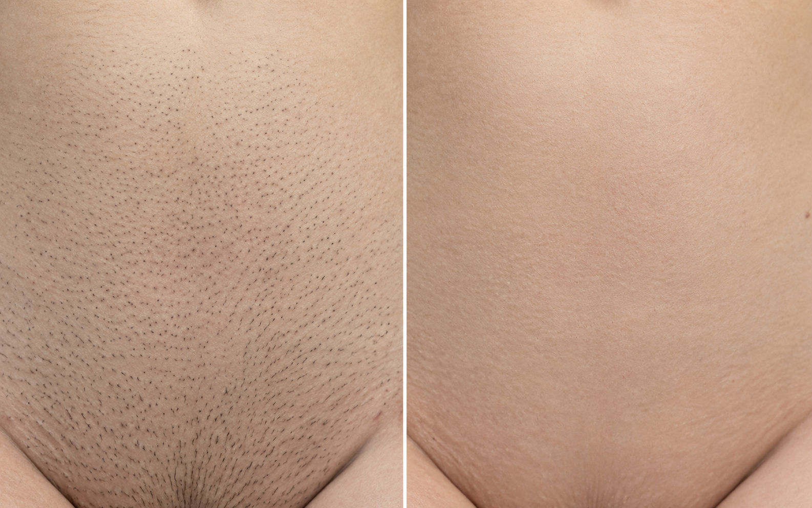 Antes e depois — Virilha